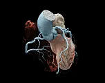 NAEOTOM Alpha.Prime in cardiology (1)